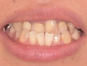 札幌南区北の沢夜間・矯正歯科。審美歯科症例。初診時の口元の写真。前歯が逆被蓋で、ほうれい線も深い。