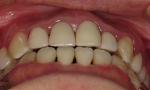 札幌南区北の沢夜間。審美歯科症例５。矯正後さらに再補綴後の写真。上顎の前歯は、根管治療、支台築造をほどこし、歯冠修復を行った。Ａ２シェード。