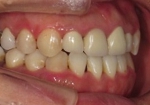 札幌南区北の沢夜間。審美歯科症例５。矯正後さらに再補綴後の写真。上顎の前歯は、根管治療、支台築造をほどこし、歯冠修復を行った。Ａ２シェード。前歯の反対咬合もきれいに矯正されました。
