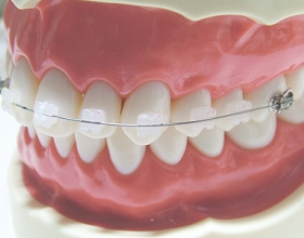 札幌南区にある歯医者で矯正の学会認定医が常勤している歯科医院は少ないです。その認定医が行っている矯正治療を紹介しています。矯正装置：レギュラータイプ矯正（ホワイトワイヤーとクリアブラケット）のモデルフォトです。