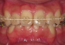 矯正歯科治療のページ、先頭画像。ホワイトコーティング審美ワイヤーによる矯正治療の症例の紹介写真。