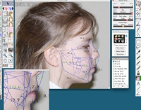 札矯正機器1。セファロ頭部X線規格撮影の分析。