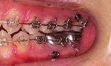 札幌南区の北の沢きたのさわ夜間歯科・矯正歯科の矯正機器。矯正用インプラント植立後の写真。開咬症例の上下臼歯部の圧下治療に使用中。デュアルトップオートスクリューを設置。