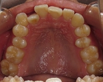 札幌南区北の沢きたのさわ夜間歯科・矯正歯の矯正症例。初診時、上顎の咬合面観。狭窄歯列。