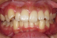 札幌南区北の沢きたのさわ夜間歯科・矯正歯科の矯正症例。矯正治療前、上下ともに中度の叢生。