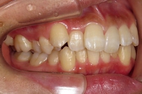 札幌南区北の沢きたのさわ夜間歯科・矯正歯科の矯正症例。矯正治療前、上下ともに中度の叢生。