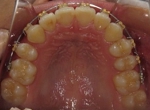 札幌南区北の沢きたのさわ夜間歯科・矯正歯科の矯正症例