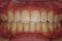 矯正症例。矯正治療後、上顎右側の4番のみを抜歯し、下顎は右5番先天欠損、左は5番欠損でE乳歯が残存のまま非抜歯矯正を行った。叢生とアーチの歪みを改善して審美と機能の両面で向上がはかられた。正面からのショット。