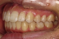 札幌南区北の沢きたのさわ夜間歯科・矯正歯科の矯正症例。矯正治療後。左側面の写真。咬合の緊密化も行われ、患者様はもとより保護者様にも満足して頂ける矯正結果となった。