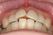 札幌南区北の沢夜間歯科・矯正歯科の矯正治療例