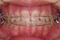 矯正症例、術中2。顎間ゴム使用中