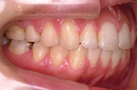 矯正症例、術後。外科的矯正治療を行わずして、強度のオープンバイトが改善できた。