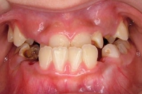 矯正症例、術前。カリエス多数、反対咬合あり。