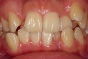 噛みあわせ矯正でバランス改善を。不正咬合の写真。叢生の症例、上顎の左側犬歯は低位唇側転位で、いわゆる八重歯。スムーズな顎運動が困難。