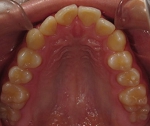 札幌。南区北の沢夜間歯科・矯正歯科の噛みあわせ矯正の症例。不正歯列の写真。矯正前（著しいＶ字歯列、狭窄アーチ）