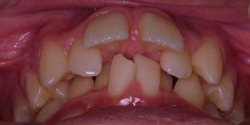 北の沢夜間歯科・矯正歯科の噛みあわせ矯正症例。施術前の不正乱ぐい歯列（下顎は後方に押し込まれている）。