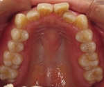 札幌。南区北の沢夜間歯科・矯正歯科の噛みあわせ矯正の症例。不正歯列の写真。矯正前（著しい台形歯列、狭窄アーチ）