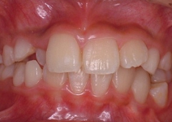 北の沢夜間歯科・矯正歯科の噛みあわせ矯正症例。下あごが横にずれている例。矯正前。