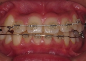 北の沢夜間歯科・矯正歯科の噛みあわせ矯正症例。矯正中、上下ワイヤーにて、咬合誘導中。ずれていたアゴは、元の位置に戻って成長している。上下の歯列正中一致。
