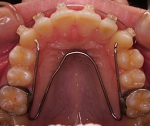 札幌。南区北の沢夜間歯科・矯正歯科の噛みあわせ矯正の症例。不正歯列の矯正中の写真。矯正中（著しいV形歯列、狭窄アーチから回復）