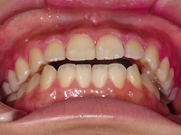 北の沢夜間歯科・矯正歯科の噛みあわせバランス矯正症例２。術前の写真。前歯の開咬状態（下顎骨の後方回転の発生が原因か？）。