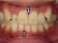 北の沢夜間歯科・矯正歯科の噛みあわせバランス矯正症例２。術後の前歯の位置修正状態。