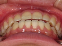 北の沢夜間歯科・矯正歯科の噛みあわせバランス矯正症例２。術後の写真。顎関節症状も回復しました。