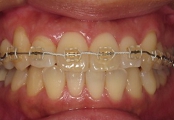 札幌南区の北の沢夜間歯科・矯正歯科の噛みあわせバランス矯正症例２。術中。スプリント療法とワイヤー矯正を併用。