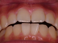 札幌南区の北の沢夜間歯科・矯正歯科の噛みあわせバランス矯正症例２。術前の写真。前歯の開咬状態（下顎骨の後方回転の発生が原因か？）。