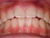 札幌南区の北の沢夜間歯科・矯正歯科の噛みあわせバランス矯正症例２。術後の前歯の位置修正状態。