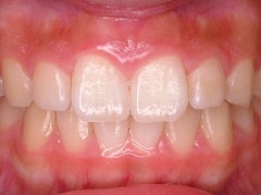 札幌南区の北の沢夜間歯科・矯正歯科の噛みあわせバランス矯正症例２。術後、かみ合わせのバランス（主に前後的）が改善されました。適切な、オーバーバイトとオーバージェット。