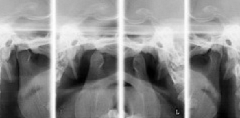 噛みあわせバランス矯正症例２。術後、顎関節パノラマ写真での顎関節の状態（左右の閉口時：両端２枚と、開口時：中央２枚）。