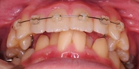 札幌南区の北の沢夜間歯科・矯正歯科の噛みあわせバランス矯正症例。前歯の矯正中（スローエキスパンジョン後）。