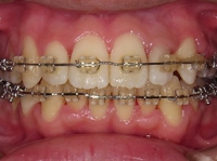北の沢夜間歯科・矯正歯科の噛みあわせ矯正症例。マルチブラケットにより矯正治療中の写真。