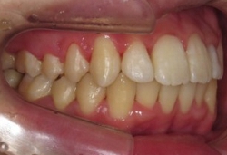 札幌南区の北の沢夜間歯科・矯正歯科の噛みあわせ矯正症例。矯正治療終了時の写真。