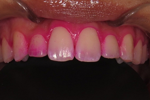 当院の予防歯科での歯面清掃PMTC器具・器材の写真。