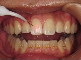 当院の予防歯科での歯面清掃PMTC器具・器材。レーザー照射中の写真。