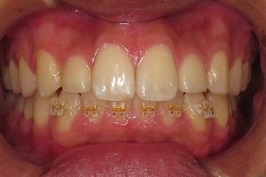 当院の予防歯科での歯面清掃PMTC器具・器材。レーザー照射中の写真。
