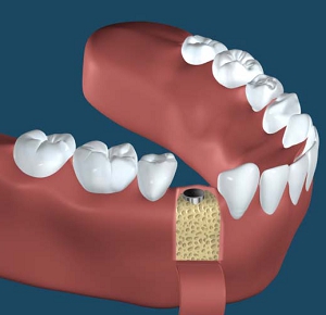 札幌の南区北の沢夜間歯科・矯正歯科のインプラント治療。ハイドロキシアパタイトコートのインプラント施術法の画像２。インプラント体の設置。