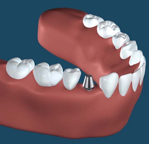 札幌の南区北の沢夜間歯科・矯正歯科のインプラント治療。ハイドロキシアパタイトコートのインプラント施術法の画像３。アバットメントの設置。