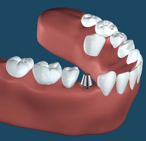 札幌の南区北の沢夜間歯科・矯正歯科のインプラント治療。ハイドロキシアパタイトコートのインプラント施術法の画像４。上部構造の設置。セラミック。