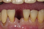 セラミック審美歯科症例。下顎前歯の１歯欠損例。欠損歯は重度の根尖性歯周炎にて抜歯済み。