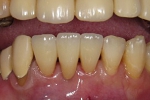 セラミック審美歯科の症例。オールセラミックスブリッジのファイナル時。