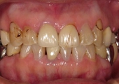 セラミック審美歯科の症例。術前の写真、旧セラミック冠の破折とカリエスによる審美障害と金属クラウンブリッジの不適合と審美不良が主訴。