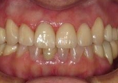 セラミック審美歯科の症例。セラミック治療後。上顎前歯部はオールセラミックスにて修復、上下臼歯部はフルジルコニアにて再補綴を行った。