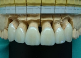 セラミック審美歯科の症例。製作されたセラミック冠の正面観写真。