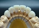 セラミック審美歯科の症例。製作されたセラミック冠の咬合面観写真。