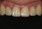 セラミック審美歯科の症例。製作されたセラミック冠を口腔内に装着後。