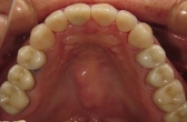 セラミック審美歯科の症例。装着されたセラミック冠の咬合面観写真。接着性レジンセメントA2使用。