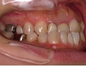 札幌南区北の沢夜間・矯正歯科。審美歯科症例。初診時の口腔内写真。前歯が逆被蓋で、前装冠とクラウンの不適合やカリエス虫歯による内部着色・変色もみられる。
